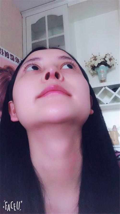 鄭州華領(lǐng)醫(yī)療美容醫(yī)院醫(yī)生張永濤做硅膠假體隆鼻怎么樣？附案例效果對比圖