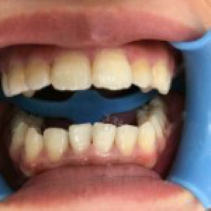 洛陽(yáng)友好口腔醫(yī)院醫(yī)生楊?lèi)?ài)芳做牙齒冷光美白怎么樣？附案例效果圖