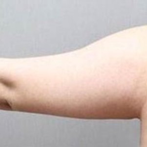 岳陽(yáng)愛思特醫(yī)療美容醫(yī)院醫(yī)生王福生做手臂吸脂怎么樣？附案例效果圖