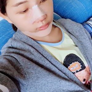 北京京民醫(yī)院整形外科醫(yī)生李鴻儒做硅膠隆鼻怎么樣？附案例效果圖