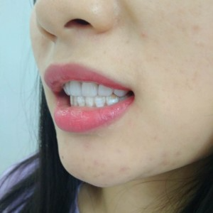 洛陽友好口腔醫(yī)院醫(yī)生李新然做牙貼面怎么樣？附案例效果圖