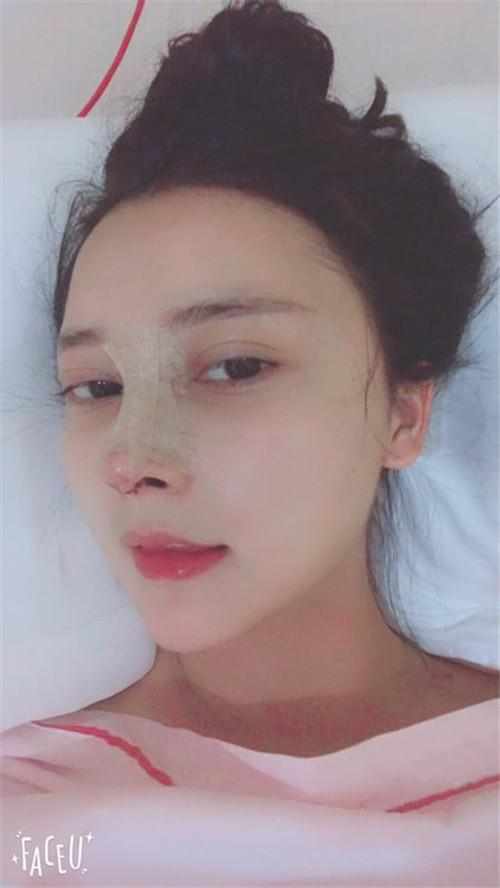 鄭州華領(lǐng)醫(yī)療美容醫(yī)院醫(yī)生張永濤做硅膠假體隆鼻怎么樣？附案例效果對比圖