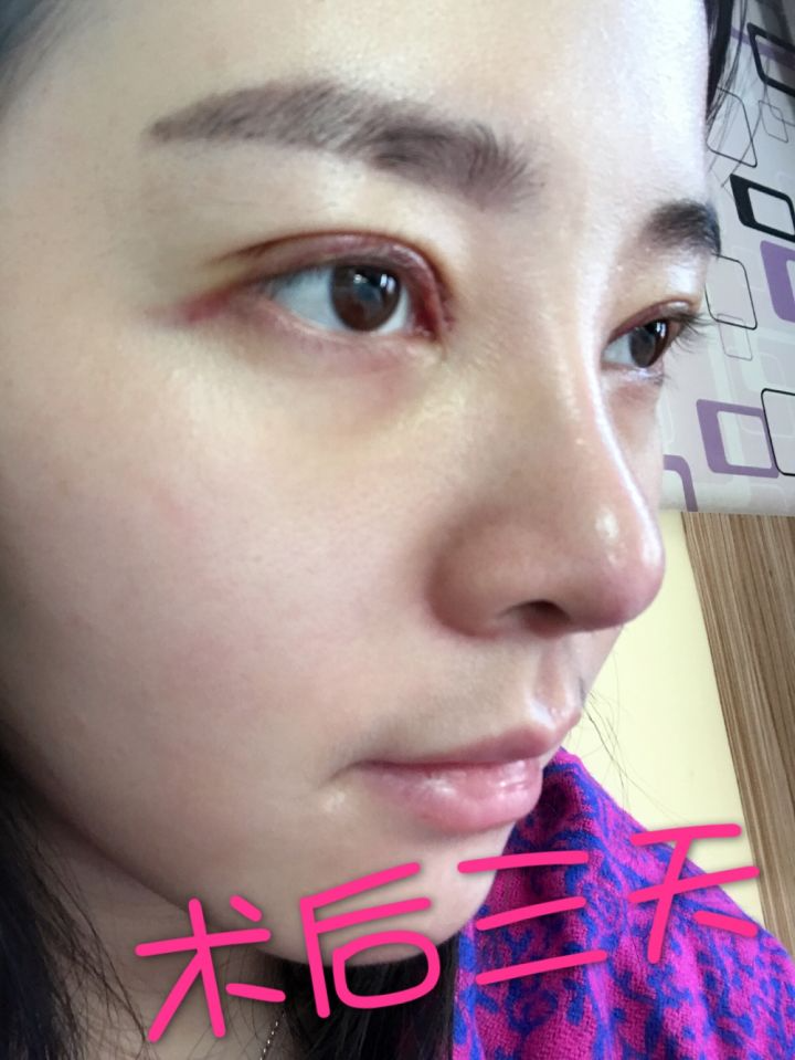 北京京韓整形醫(yī)生王義山做埋線雙眼皮怎么樣？附案例效果對比圖