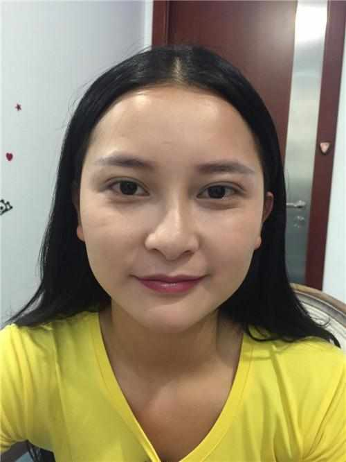 鄭州華領(lǐng)醫(yī)療美容醫(yī)院醫(yī)生張永濤做硅膠假體隆鼻怎么樣？附案例效果對比圖