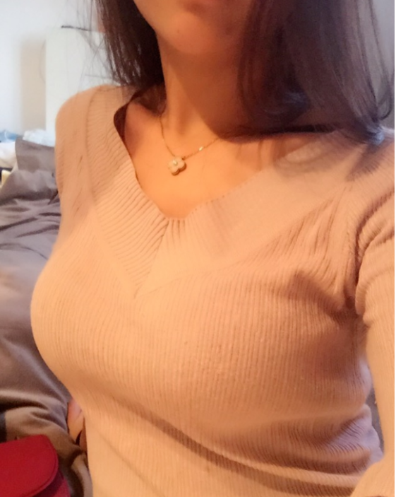 東莞韓美整形醫(yī)院醫(yī)生黃玉潔做假體隆胸怎么樣？附案例效果圖