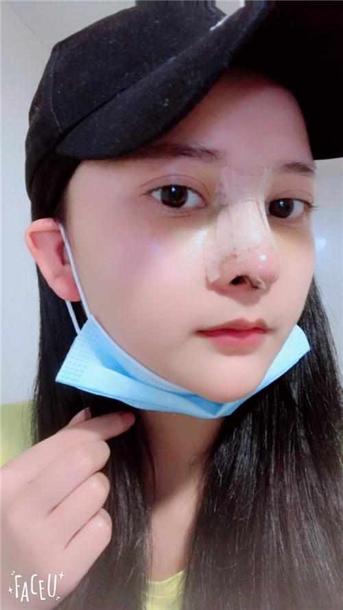 鄭州華領(lǐng)醫(yī)療美容醫(yī)院醫(yī)生張永濤做硅膠假體隆鼻怎么樣？附案例效果對比圖