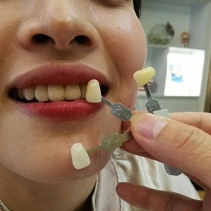 上?？仆呖谇会t(yī)院醫(yī)生鄧建儒做牙齒冷光美白怎么樣？附案例效果對比圖