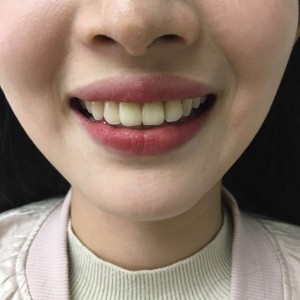 上?？仆呖谇会t(yī)院醫(yī)生鄧建儒做牙齒冷光美白怎么樣？附案例效果對比圖