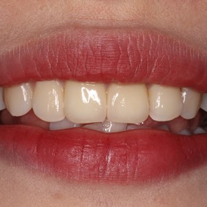 上?？仆呖谇会t(yī)院醫(yī)生鄧建儒做牙齒冷光美白怎么樣？附案例效果對比圖