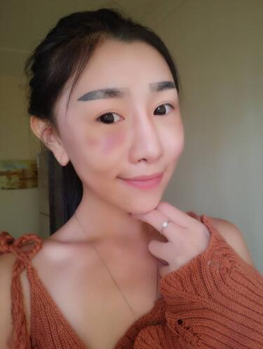 貴陽泰康樂醫(yī)院整形美容科醫(yī)生陳璐做自體脂肪全臉填充效果怎么樣？