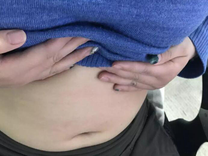 廣州尚美善造美容醫(yī)院醫(yī)生邵方做水動力吸脂怎么樣？附案例效果圖