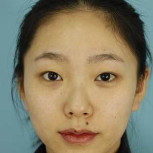 鄭州安格潤整形醫(yī)生楊曉紅做雙眼皮手術怎么樣？附案例效果圖