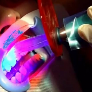 北京美年口腔醫(yī)院醫(yī)生劉海濤做牙齒冷光美白怎么樣？附案例效果對比圖