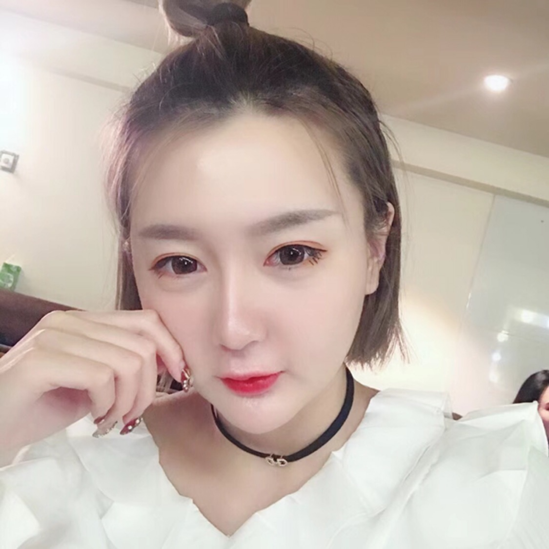 杭州格萊美整形美容醫(yī)院醫(yī)生張霞飛做自體脂肪全臉填充效果怎么樣？