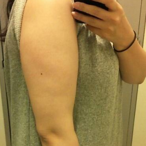 長(zhǎng)沙柒和醫(yī)療整形醫(yī)生鐘滔做手臂吸脂怎么樣？附案例效果對(duì)比圖