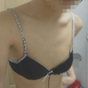 三亞圣迪亞整形美容醫(yī)院醫(yī)生韓超做假體隆胸怎么樣？附案例效果對比圖