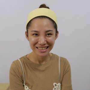 保定東陽口腔醫(yī)院醫(yī)生白小青做牙齒冷光美白怎么樣？附案例效果對比圖