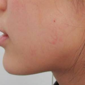 蚌埠韓美美萊整形醫(yī)院醫(yī)生張濤做玻尿酸墊下巴怎么樣？來看案例效果圖