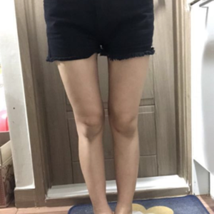 貴陽華美整形美容醫(yī)院醫(yī)生田永華做大腿吸脂效果怎么樣？附大腿吸脂案例前后對(duì)比圖