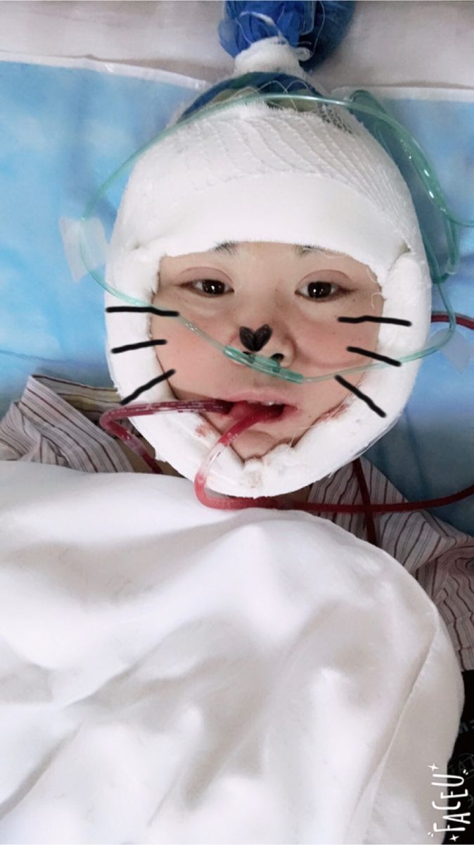 北京彤美美容整形醫(yī)院醫(yī)生楊曉惠做顴骨內推+面部吸脂手術效果怎么樣？附案例