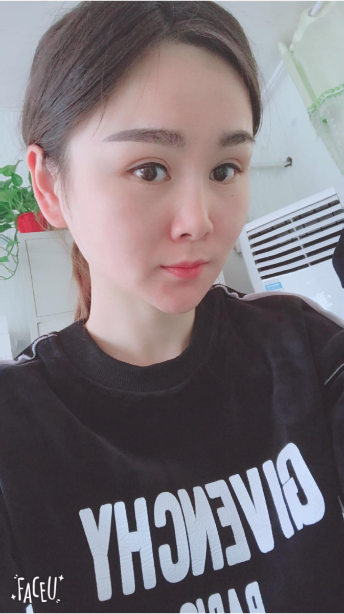 北京彤美美容整形醫(yī)院醫(yī)生楊曉惠做顴骨內推+面部吸脂手術效果怎么樣？附案例