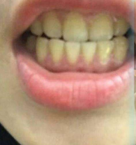 淄博口腔醫(yī)院醫(yī)生牟象鑫做超聲波洗牙怎么樣？附案例效果對比圖