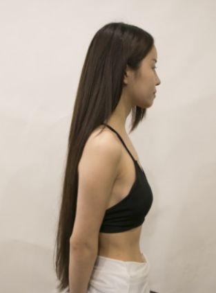 吉林現(xiàn)代整形美容醫(yī)院做假體隆胸效果怎么樣？附醫(yī)院案例效果對(duì)比圖