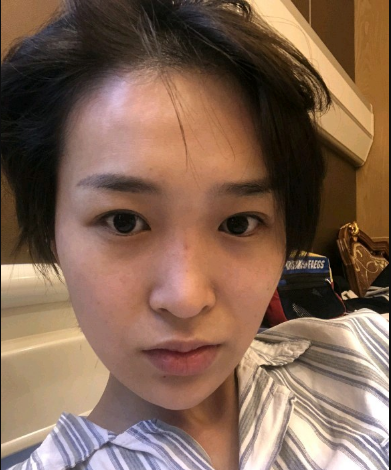 武漢米蘭醫(yī)療美容醫(yī)生柳再億做眼綜合+鼻綜合整形怎么樣？附真實(shí)案例對(duì)比圖