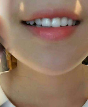 淄博口腔醫(yī)院醫(yī)生牟象鑫做超聲波洗牙怎么樣？附案例效果對比圖