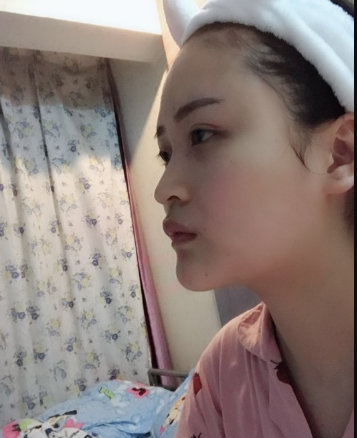 北京伊美爾美容愛(ài)康醫(yī)院醫(yī)生柳成做鼻綜合整形怎么樣？附案例效果圖