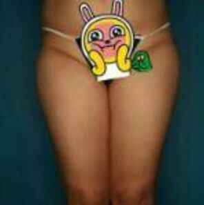 貴陽華美整形美容醫(yī)院醫(yī)生田永華做大腿吸脂效果怎么樣？附大腿吸脂案例前后對(duì)比圖