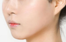 福州市第一醫(yī)院自體脂肪豐額頭