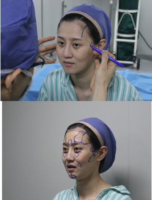 上海時(shí)光整形醫(yī)院自體脂肪填充臉部真實(shí)效果圖分享 上海時(shí)光整形醫(yī)院自體脂肪填充臉部真實(shí)效果圖分享