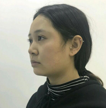 上海時光整形醫(yī)院做豐下巴怎么樣？許黎平醫(yī)生豐下巴案例分享