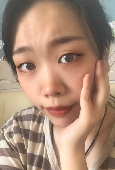 合肥韓美整形美容醫(yī)院做去眼袋效果怎么樣?附金壽信醫(yī)生去眼袋案例效果圖