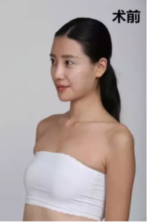 上海時光整形醫(yī)院何晉龍醫(yī)生做假體隆胸怎么樣？附案例對比圖