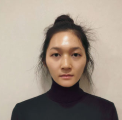 上海時光整形醫(yī)院做面部玻尿酸注射效果怎么樣？