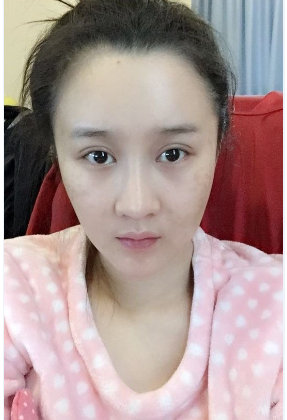 上海時(shí)光整形醫(yī)院自體脂肪填充臉部真實(shí)效果圖分享 上海時(shí)光整形醫(yī)院自體脂肪填充臉部真實(shí)效果圖分享