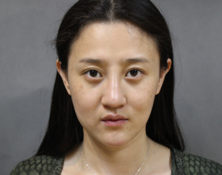 上海時光整形醫(yī)院自體脂肪填充臉部真實效果圖分享