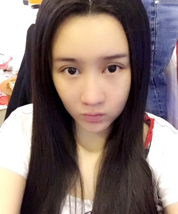 上海時(shí)光整形醫(yī)院自體脂肪填充臉部真實(shí)效果圖分享 上海時(shí)光整形醫(yī)院自體脂肪填充臉部真實(shí)效果圖分享