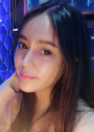 鞍山王景醫(yī)療美容外科診所做自體脂肪豐蘋果肌效果怎么樣？附張婉鸝案例效果圖