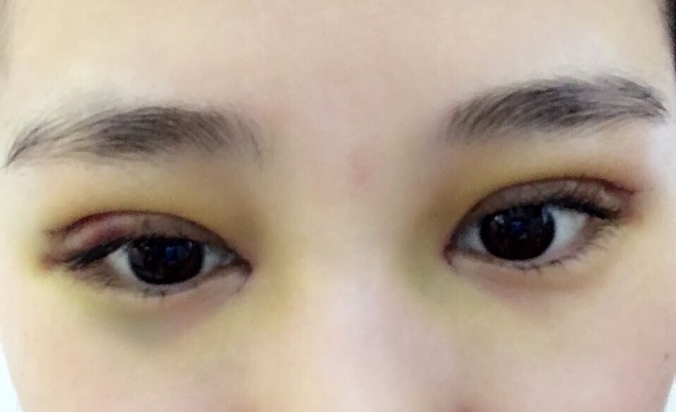 蚌埠韓美美萊整形醫(yī)生鄭捷做開眼角怎么樣？附案例效果圖