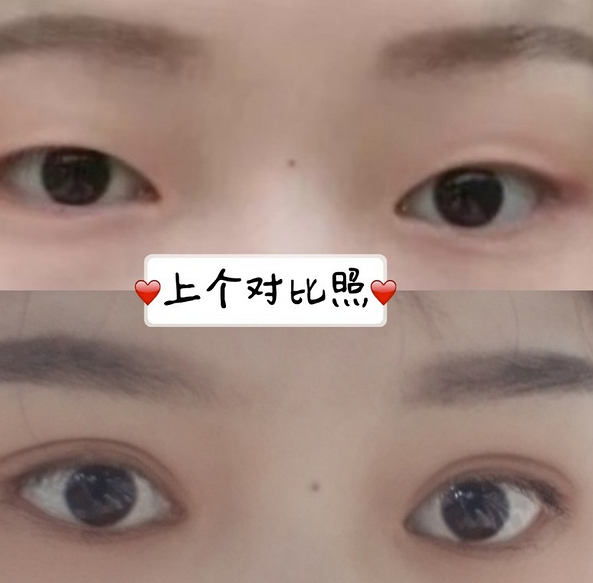 鞍山菲之都醫(yī)療整形醫(yī)院做開眼角+全切雙眼皮效果怎么樣？附藺嬌婷醫(yī)生案例