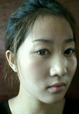 鞍山菲之都整形醫(yī)生李宗亮做字體脂肪豐太陽穴效果怎么樣？附案例效果對(duì)比圖