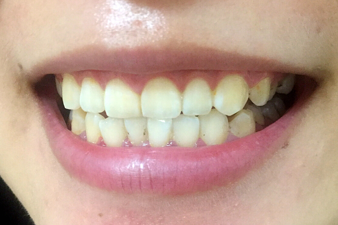 安慶渡江口腔醫(yī)院張良斌醫(yī)生做超聲波洗牙效果怎么樣？附洗牙案例效果圖