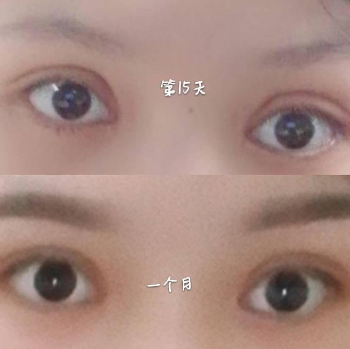 雙眼皮案例效果對比照