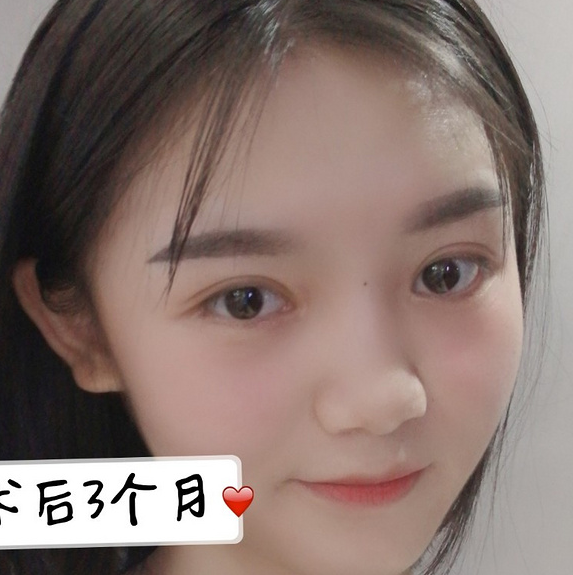 鞍山菲之都醫(yī)療整形醫(yī)院做開眼角+全切雙眼皮效果怎么樣？附藺嬌婷醫(yī)生案例