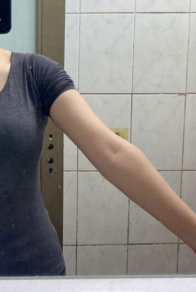 蚌埠市第三人民醫(yī)院燒傷整形科楊蔚做手臂吸脂效果對(duì)比圖