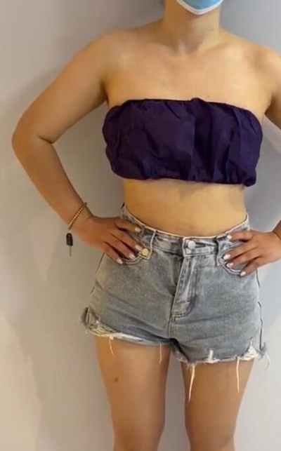 蚌埠市第三人民醫(yī)院燒傷整形科楊蔚做手臂吸脂效果對(duì)比圖