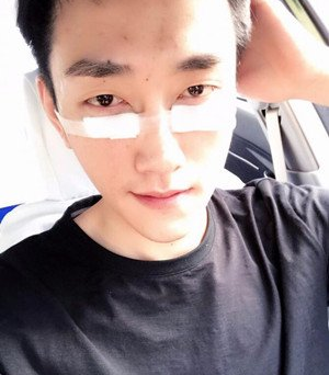 鞍山燕麗醫(yī)療美容醫(yī)院薛媚醫(yī)生做去眼袋效果怎么樣？附案例效果對比圖